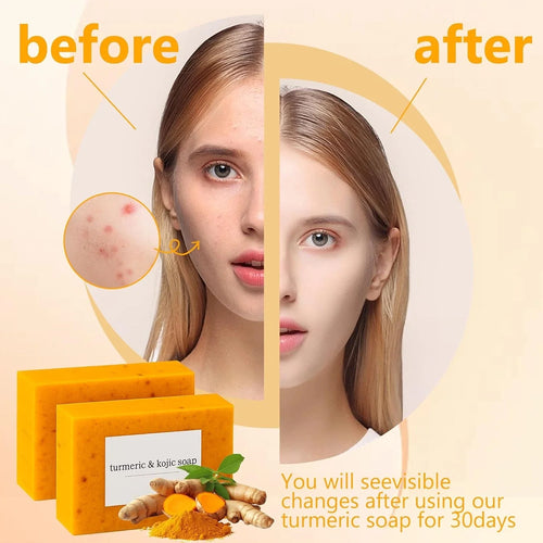 3-Pack Turmeric Glow Soap Bar - Lemon & Kojic Acid, Removing Dark Spots
